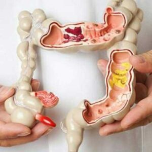 ورزش و افزایش طول عمر در بازماندگان سرطان روده بزرگ