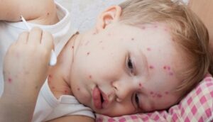 فصل بهار و شیوع گسترده «آبله مرغان»