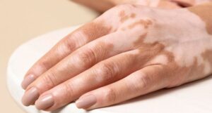 ویتیلیگو؛ فراتر از یک بیماری پوستی