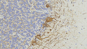 نشانه‌های خونی اسکلروز چندگانه را سال‌ها قبل نشان می‌دهند