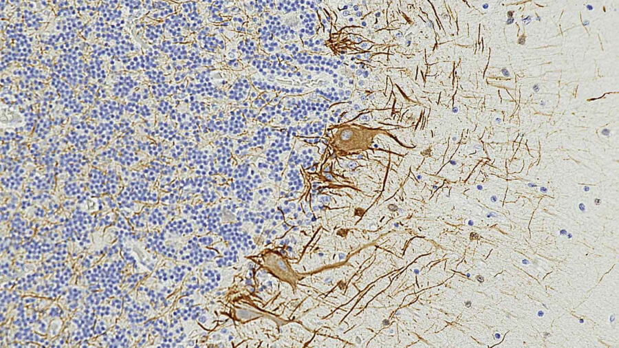 نشانه‌های خونی اسکلروز چندگانه را سال‌ها قبل نشان می‌دهند