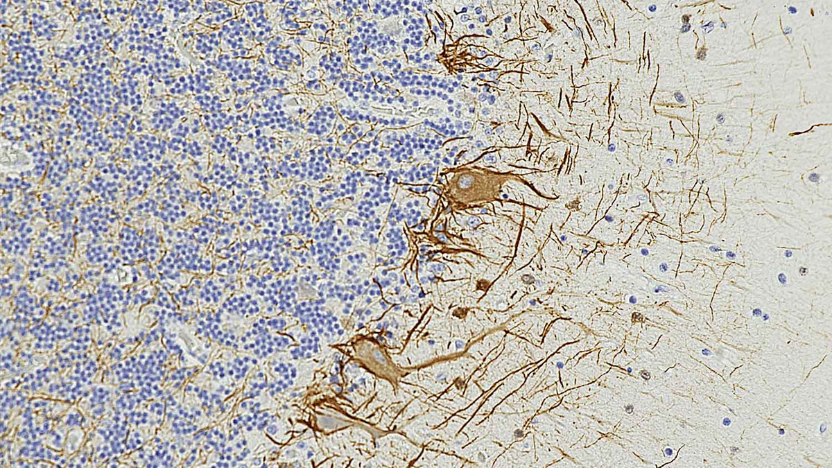 نشانه‌های خونی اسکلروز چندگانه را سال‌ها قبل نشان می‌دهند