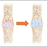 انقلاب ایران در پزشکی بازساختی با رونمایی از پیشرفته‌ترین پیوند استخوان نانویی