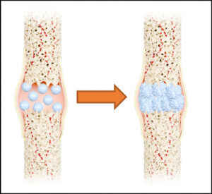 انقلاب ایران در پزشکی بازساختی با رونمایی از پیشرفته‌ترین پیوند استخوان نانویی