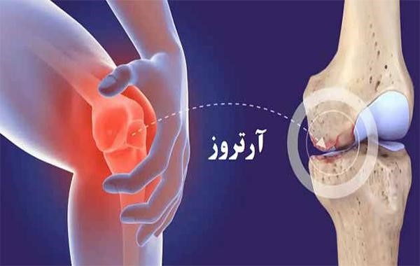 مطالعه جدید: نقش مکمل‌های پری‌بیوتیک در کاهش درد آرتروز زانو
